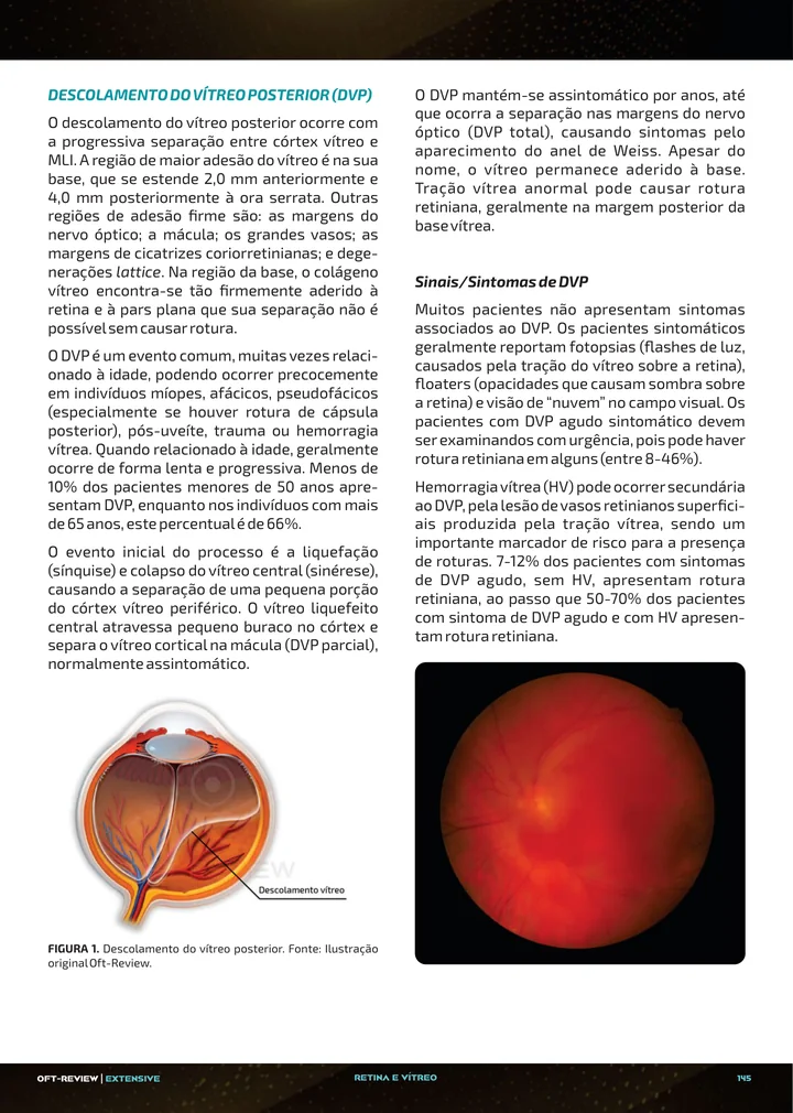 Página interna da apostila sobre Descolamento do vítreo posterior, degeneração lattice e roturas