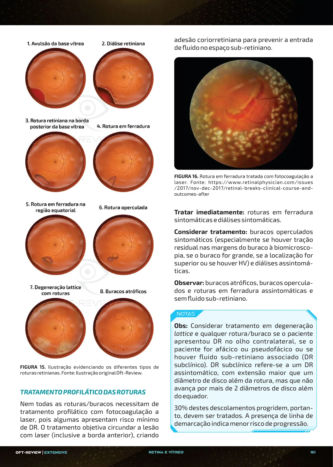Página da apostila Descolamento do vítreo posterior, degeneração lattice e roturas